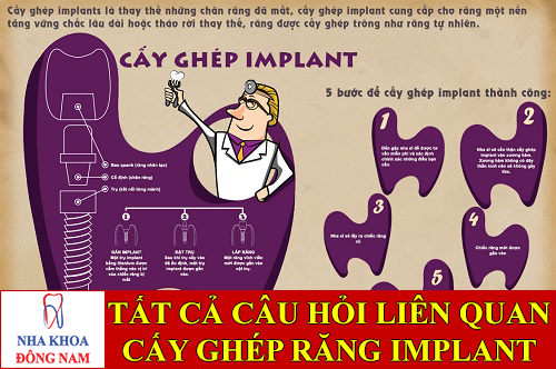 tất cả câu hỏi về cấy ghép răng implant -1