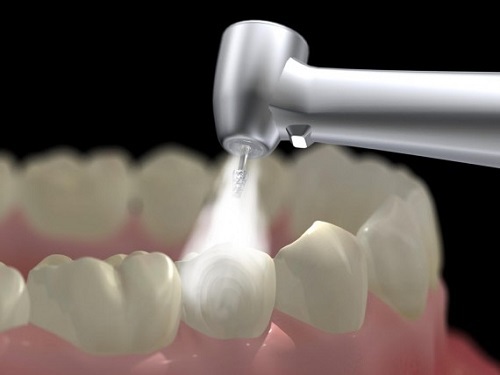 trám răng composite có bền không -3