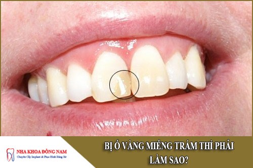 bị ố vàng miếng trám răng thì phải làm sao