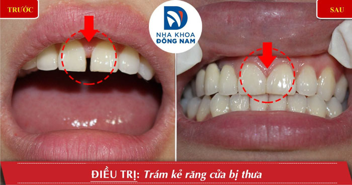 Trám răng thưa đem lại thẩm mỹ tự nhiên