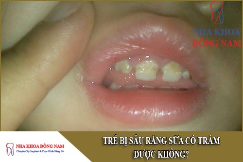 trẻ bị sâu răng sữa có trám được không