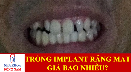 trồng implant cho răng bị mất -1