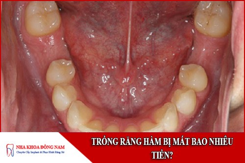 trồng răng hàm bị mất bao nhiêu tiền