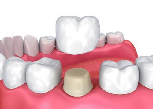 kỹ thuật bọc răng sứ