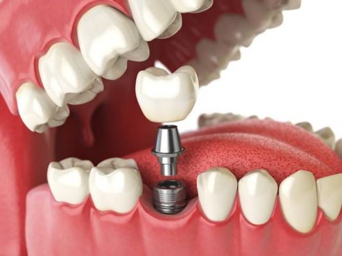 trồng răng sứ trên Implant
