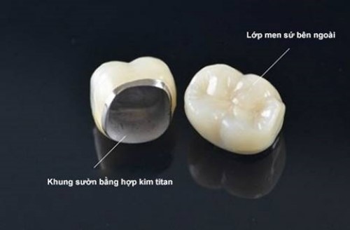 Cấu tạo của răng sứ titan