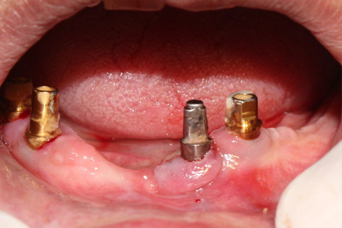 Trụ Implant gặp biến chứng viêm nhiễm