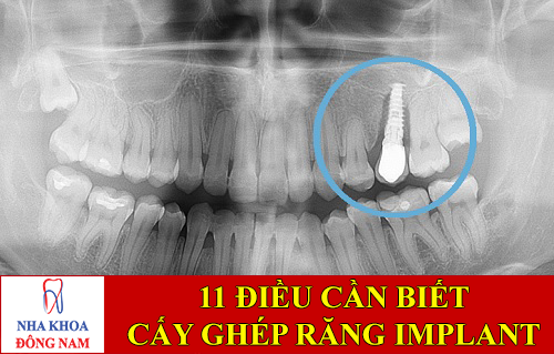 11 điều cần biết về dịch vụ cấy ghép răng implant -1