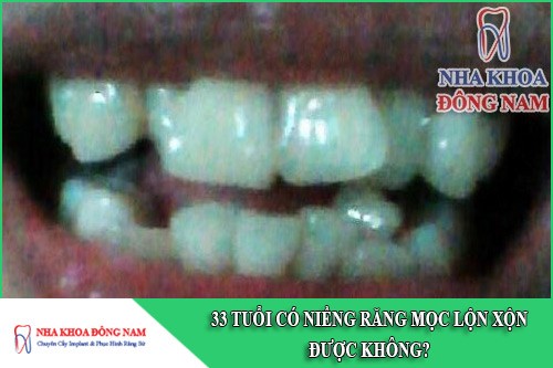 33 tuổi có niềng răng mọc lộn xộn được không