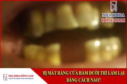 bị mất răng cửa hàm dưới thì làm lại bằng cách nào