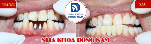 bị mất răng cửa hàm dưới thì làm lại bằng cách nào 3