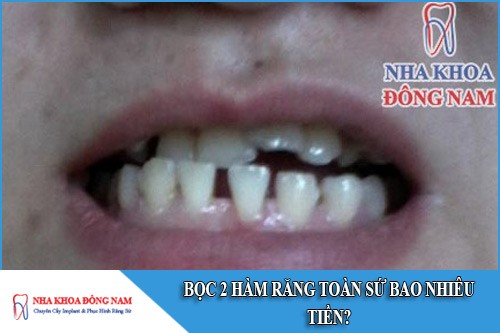 bọc 2 hàm răng toàn sứ bao nhiêu tiền