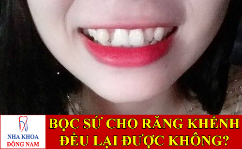 bọc răng sứ cho răng khểnh đều được không -1
