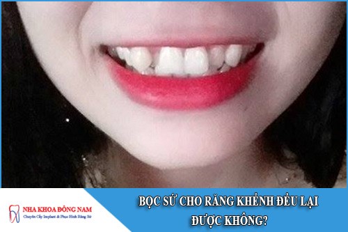 bọc răng sứ cho răng khểnh đều được không