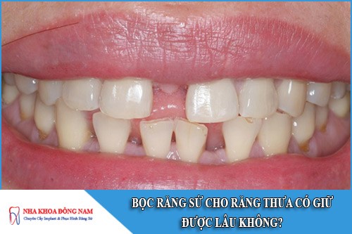 bọc răng sứ cho răng thưa có giữ được lâu không?