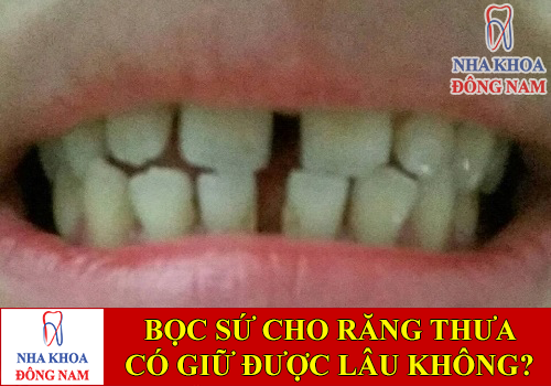 bọc răng sứ cho răng thưa có giữ được lâu không -1
