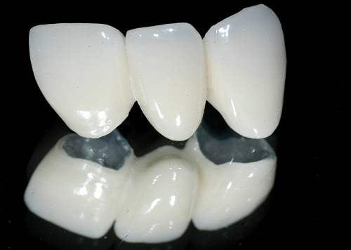 bọc răng sứ cho răng thưa có giữ được lâu không -5