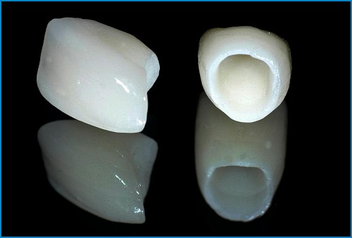 răng toàn sứ - Bọc răng sứ cho răng thưa có giữ được lâu không