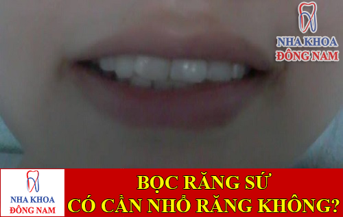 bọc răng sứ có cần phải nhổ răng không -1
