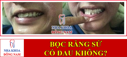 bọc răng sứ có đau không -1