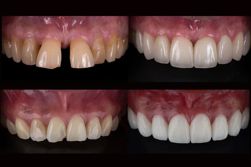 Bọc sứ cho răng thưa giúp cải thiện thẩm mỹ và ngăn ngừa bệnh lý nguy hiểm