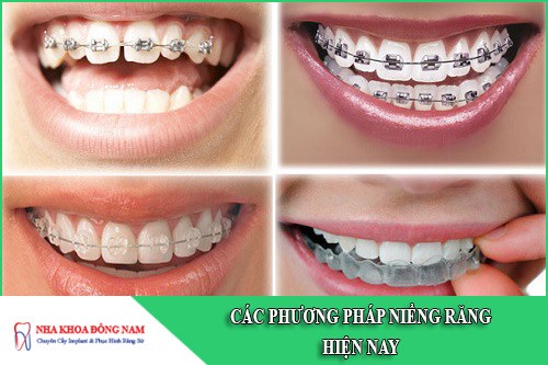 các phương pháp niềng răng hiện nay