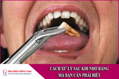 cách xử lý sau khi nhổ răng mà bạn cần phải biết