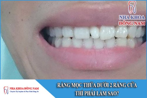 răng mọc thừa giữa 2 răng cửa thì phải làm sao