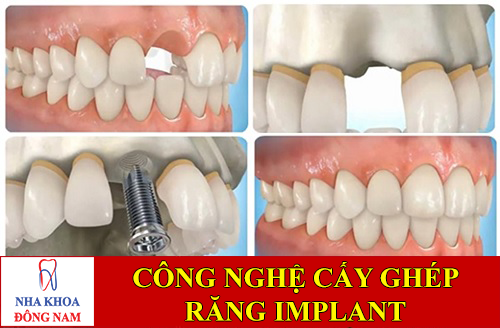 công nghệ cấy ghép răng implant -1