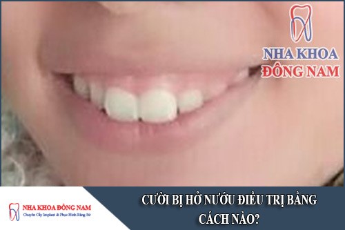 cười bị hở nướu điều trị bằng cách nào
