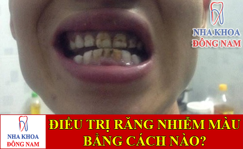 điều trị răng bị nhiễm màu từ nhỏ bằng cách nào -1