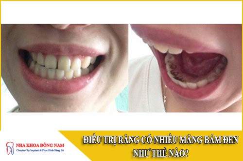 điều trị răng có nhiều mãng bám đen như thế nào