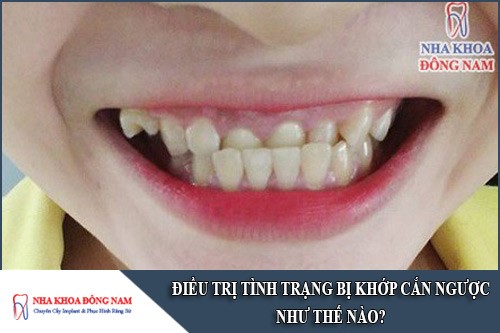 điều trị tình trạng bị khớp cắn ngược như thế nào