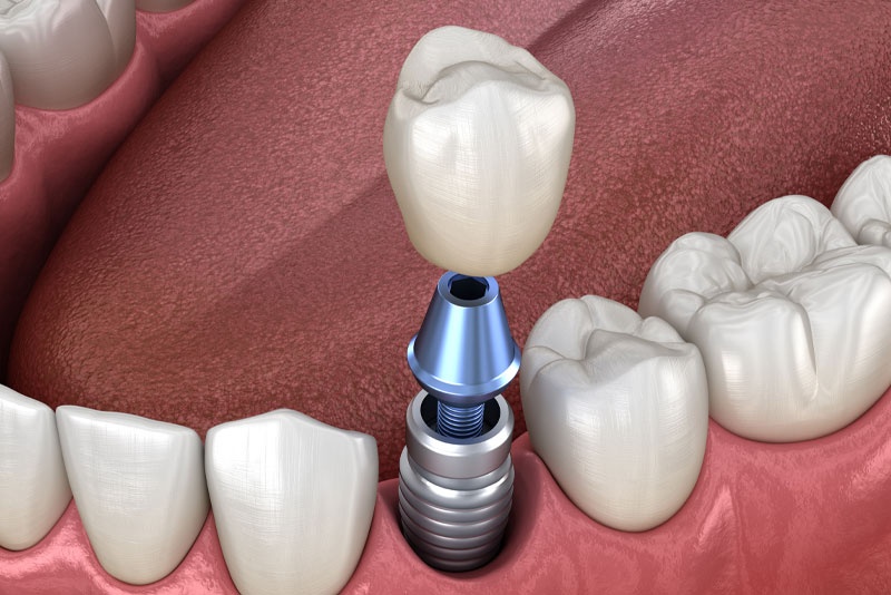 Implant là phương pháp tối ưu thay thế cầu răng sứ