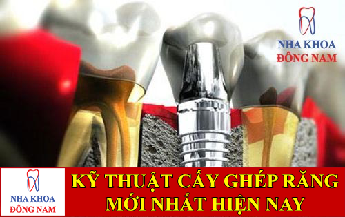 kỹ thuật cấy ghép răng implant mới nhất -1
