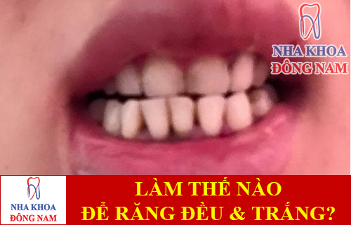 làm thế nào để răng đều và trắng hơn -1