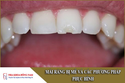 mài răng bị mẻ và các phương pháp phục hình