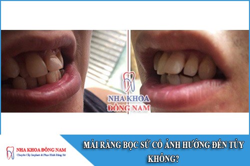 mài răng bọc sứ có ảnh hưởng đến tủy không