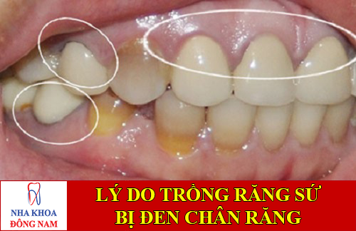 nguyên nhân trồng răng sứ bị đen chân răng -1