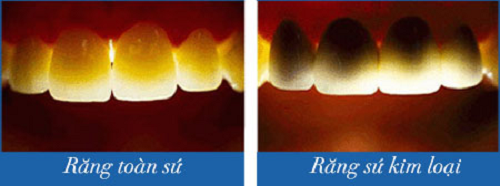 nguyên nhân trồng răng sứ bị đen chân răng -3