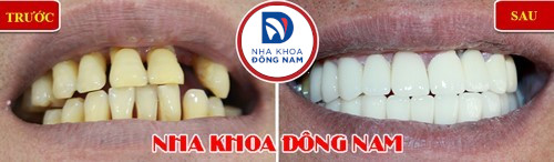 bọc răng sứ cho 2 hàm răng thưa và xỉn màu