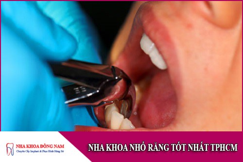 nha khoa nhổ răng tốt nhất tphcm