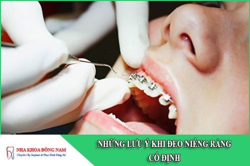 những lưu ý khi đeo niềng răng cố định