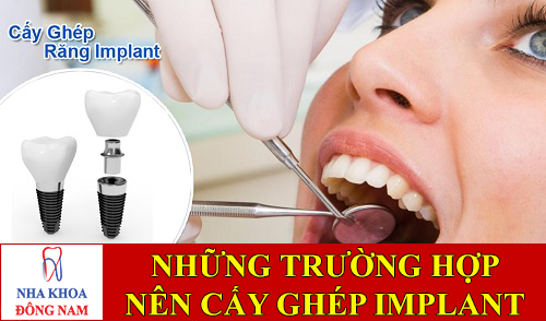 những trường hợp nào nên cấy ghép răng implant -1