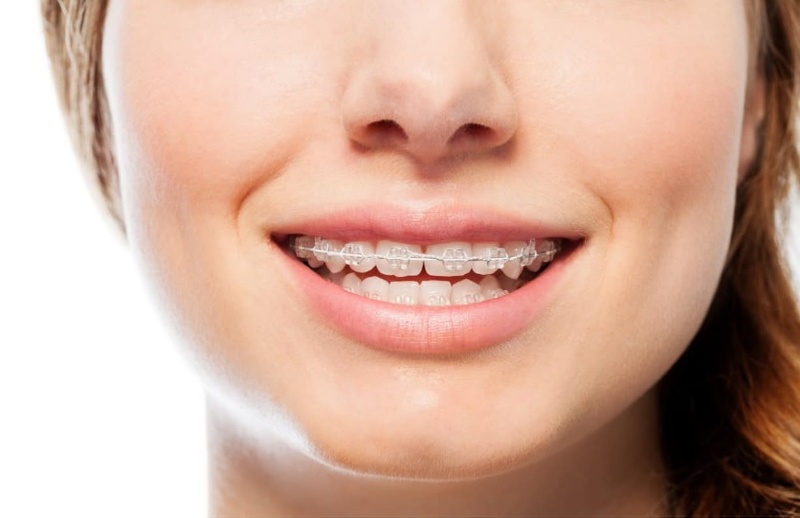Niềng răng cho trường hợp khoảng thưa rộng