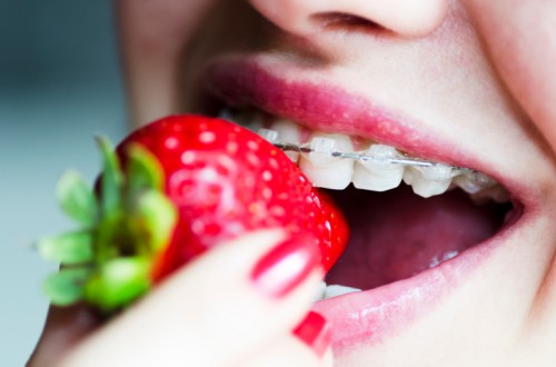 niềng răng có ảnh hưởng đến việc ăn uống không -3