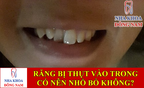 răng bị thụt vào trong có nên nhổ bỏ không -1
