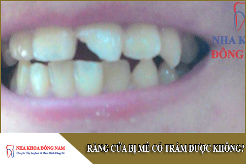 răng cửa bị mẻ có trám được không