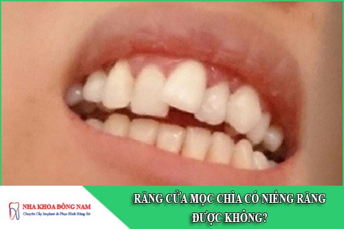 răng cửa mọc chìa có niềng răng được không