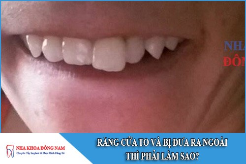 răng cửa to và bị đưa ra ngoài thì phải làm sao